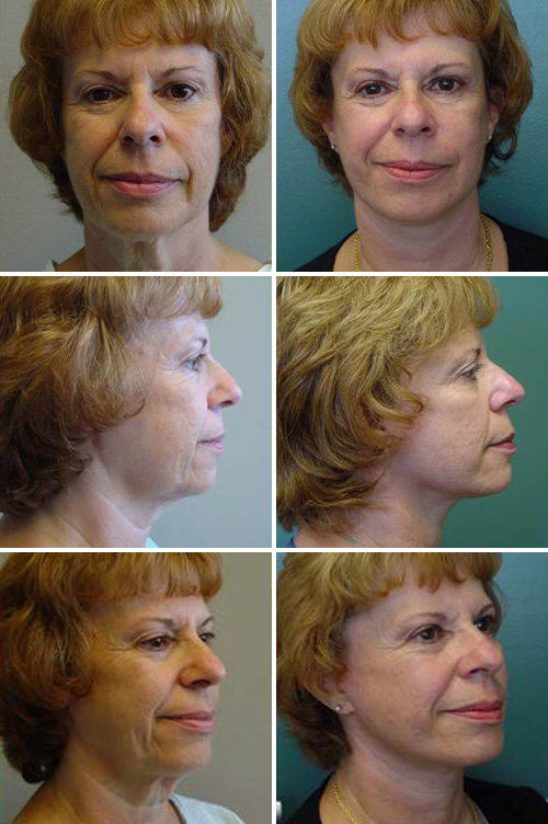 Facelift Before & After Photos