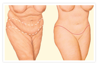 FAQs About Post-Bariatric Body Contouring