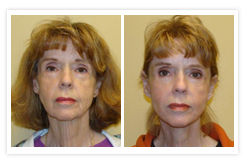 Facelift Before & After Photos