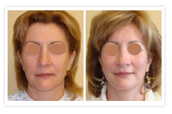 Facelift Before & After Photos